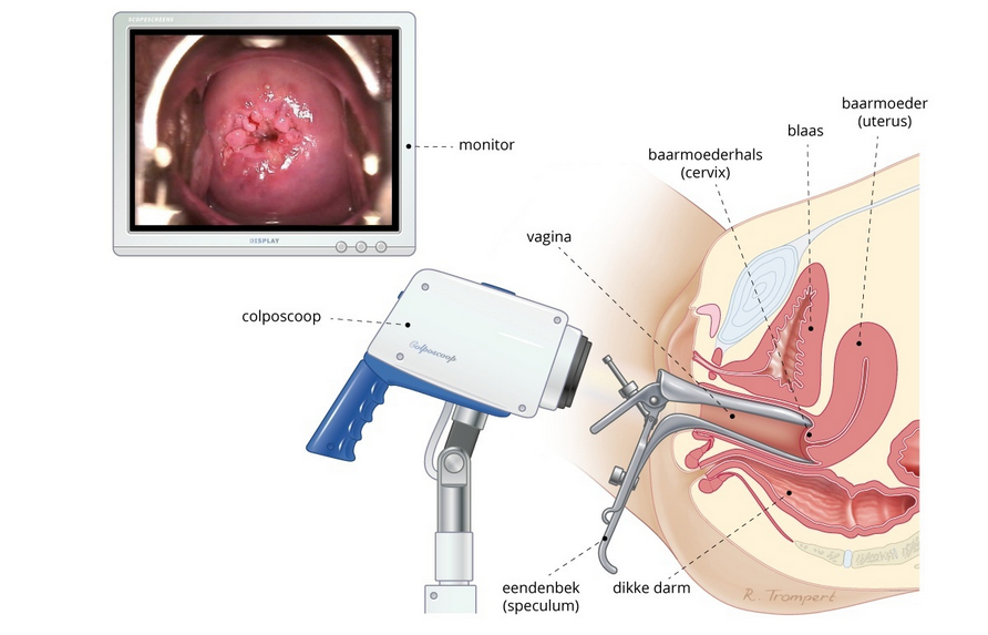  كيف يتم تشخيص الثاليل التناسلية؟